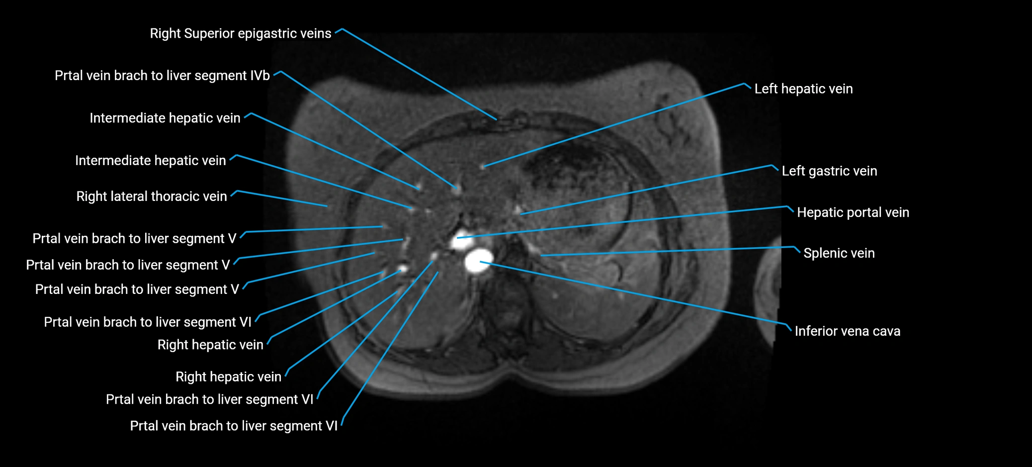 MRV abdomen pelvis & lower limb axial cross sectional anatomy labelled MRI image 42 (1).webp